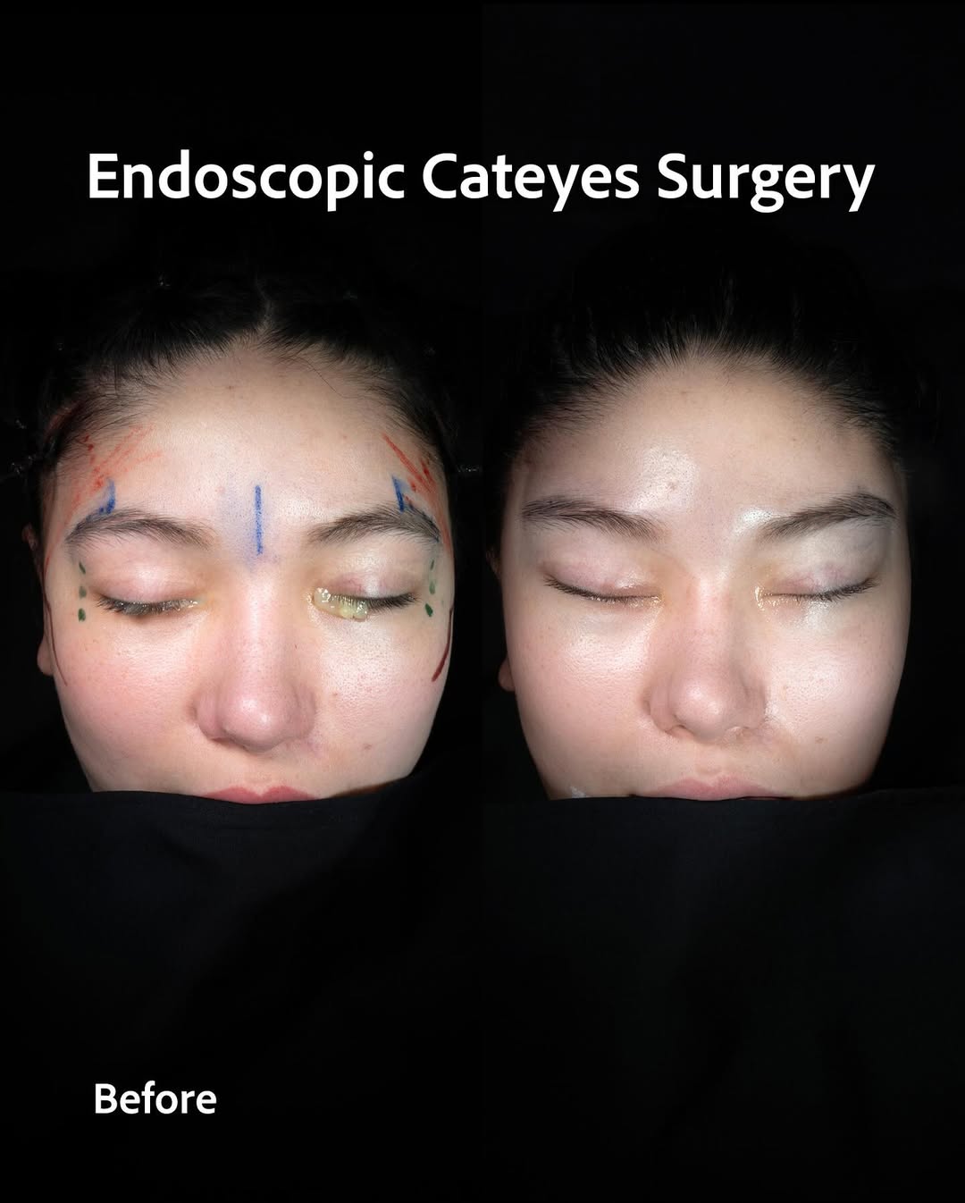 Fox Eye Surgery performed by Op. Dr. Erdi Özdemir