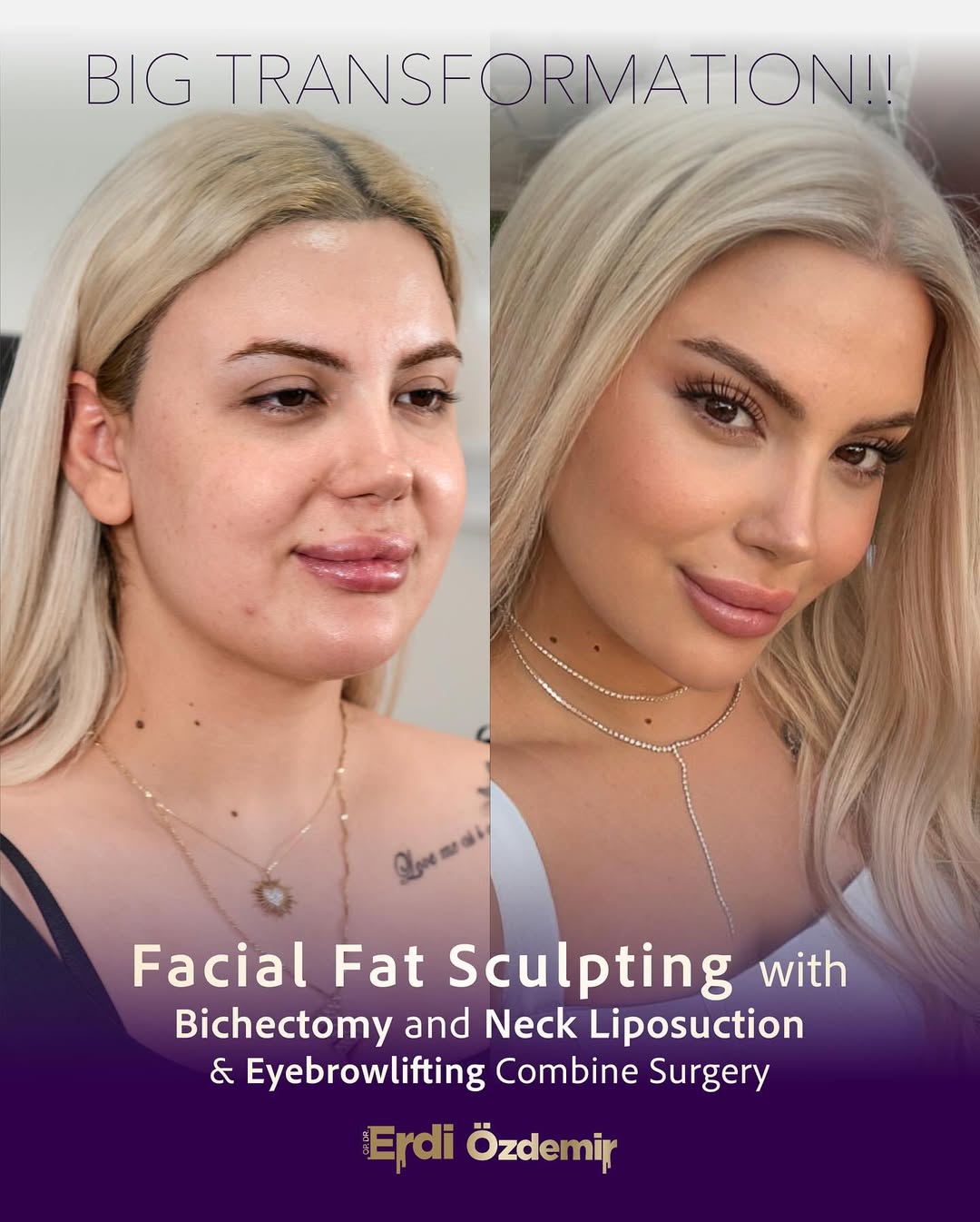 Eyebrow Lift Surgery performed by Op. Dr. Erdi Özdemir