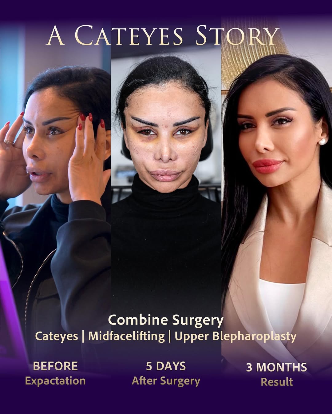 Fox Eye Surgery performed by Op. Dr. Erdi Özdemir