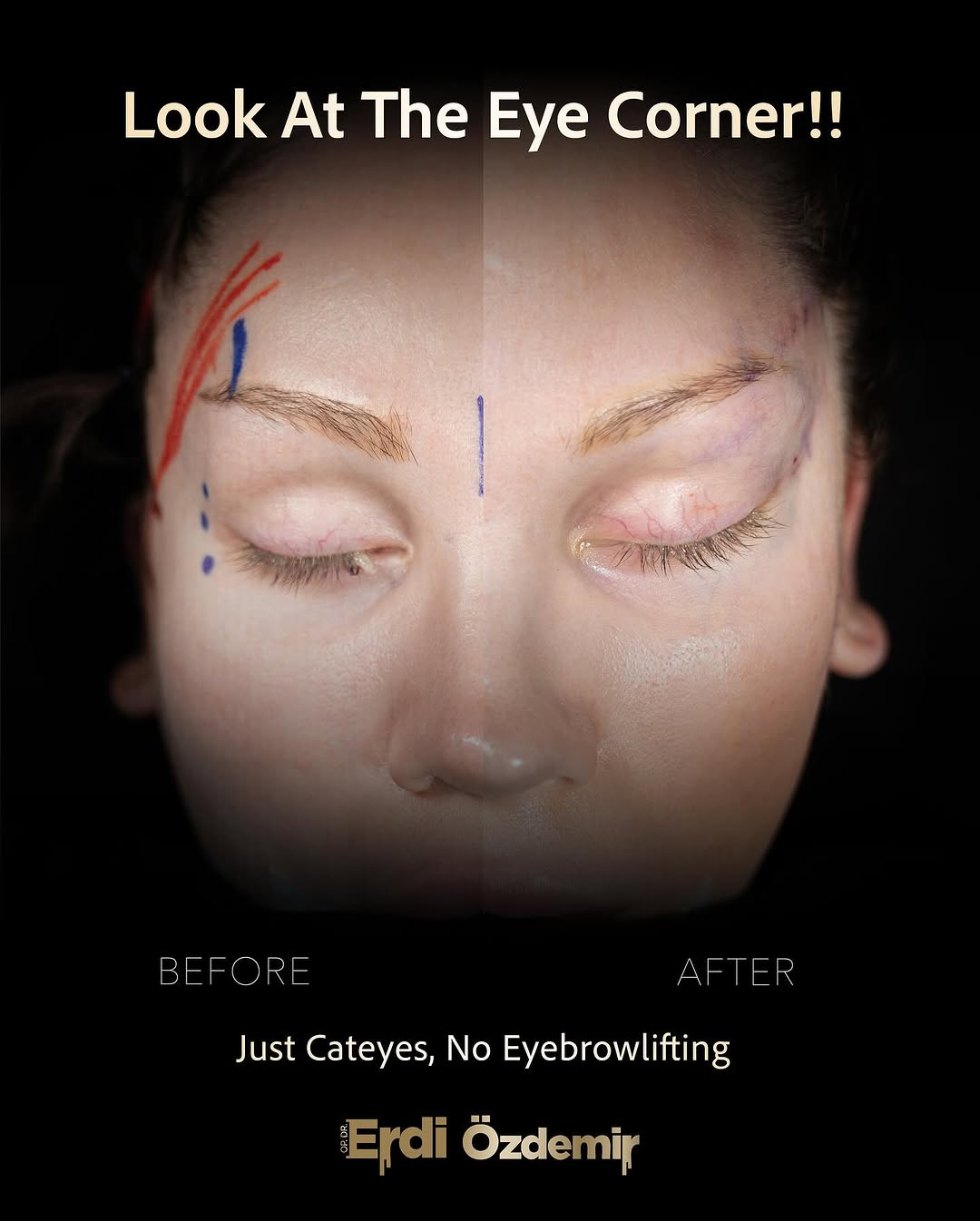 Fox Eye Surgery performed by Op. Dr. Erdi Özdemir