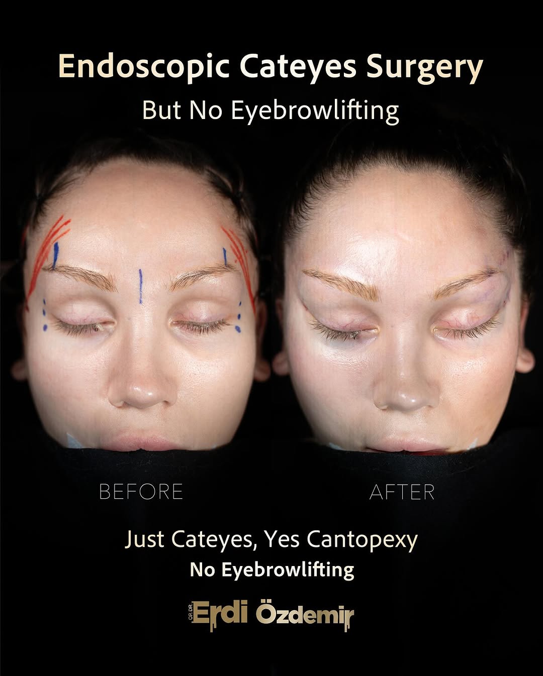 Fox Eye Surgery performed by Op. Dr. Erdi Özdemir