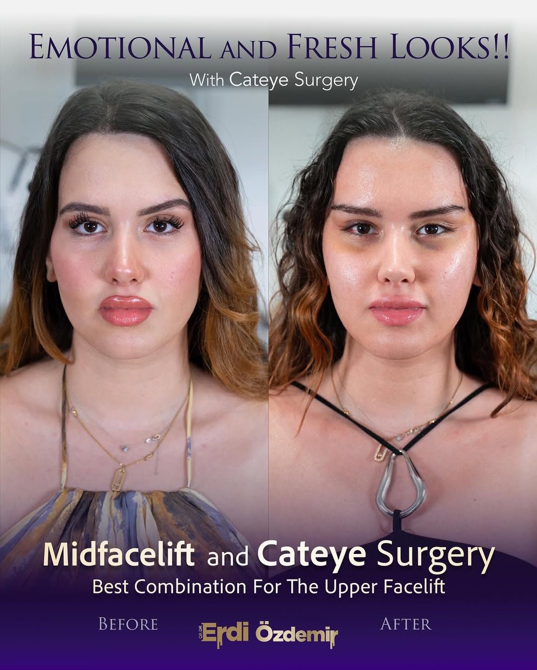 Fox Eye Surgery performed by Op. Dr. Erdi Özdemir
