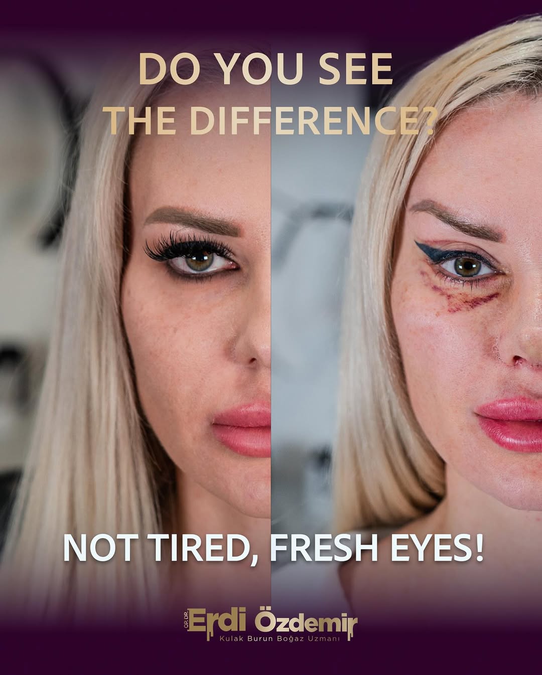 Fox Eye Surgery performed by Op. Dr. Erdi Özdemir