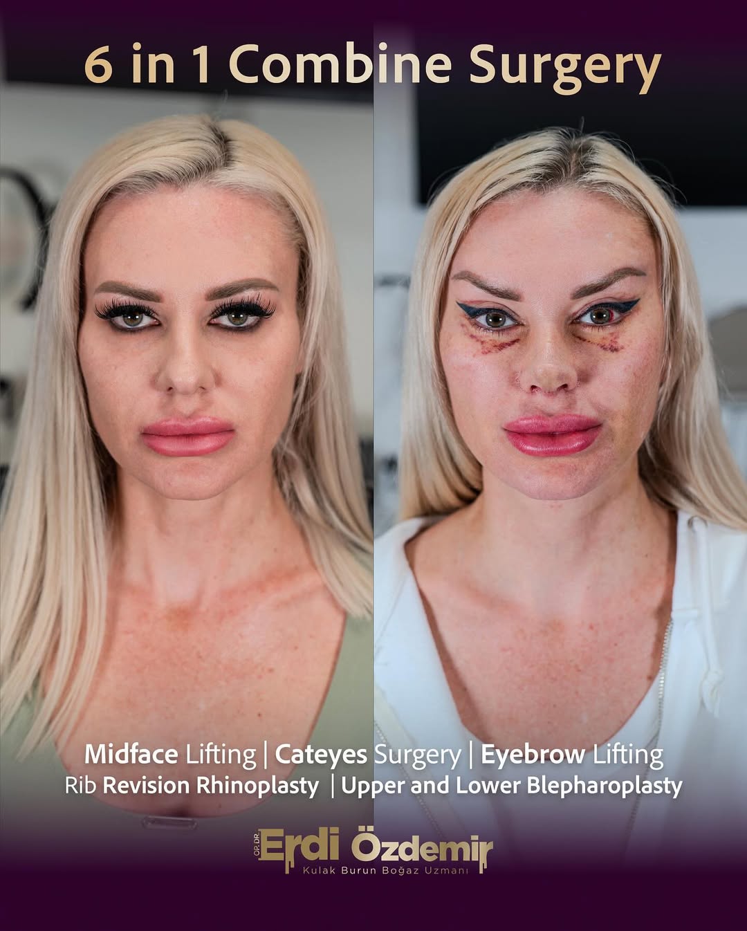 Fox Eye Surgery performed by Op. Dr. Erdi Özdemir