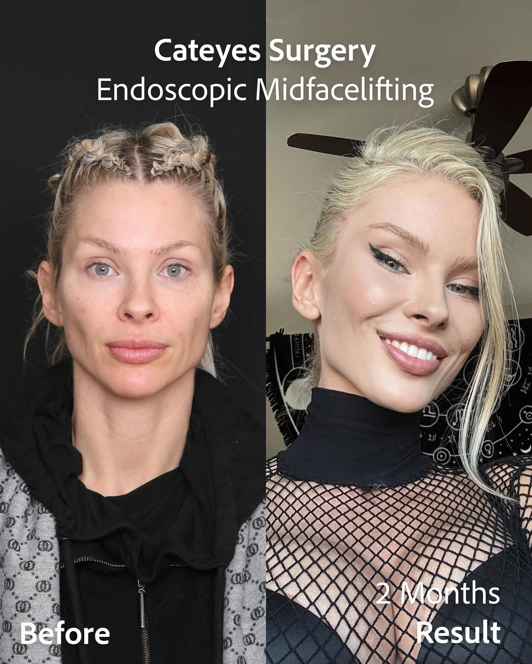 Fox Eye Surgery performed by Op. Dr. Erdi Özdemir