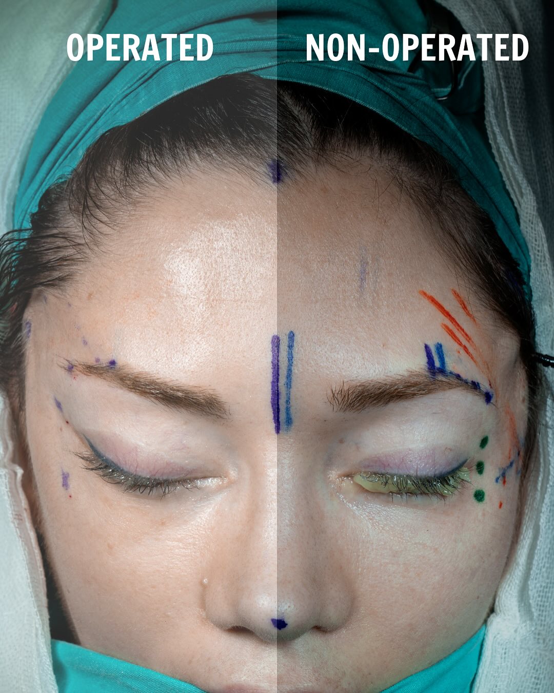 Fox Eye Surgery performed by Op. Dr. Erdi Özdemir